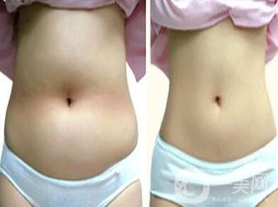 360吸脂減肥,多少錢(qián)