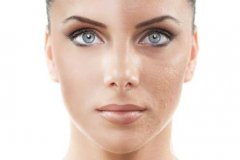 果酸換膚的危害 后遺癥主要有哪些？