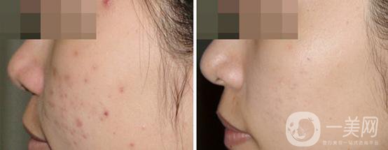 果酸換膚的危害 后遺癥主要有哪些？