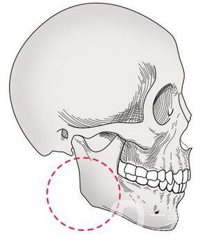 下頜角截骨手術(shù)頭套戴多久 恢復(fù)期要多久？