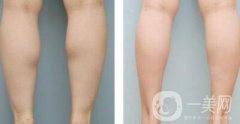 注射瘦腿果好嗎 打注射瘦腿怎么樣