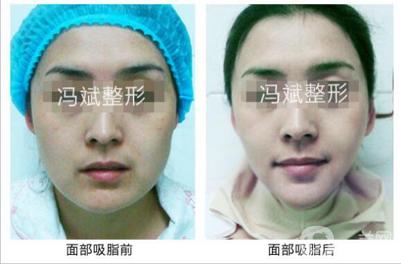 北京東方和諧馮斌整形價格表2018國慶特惠出爐