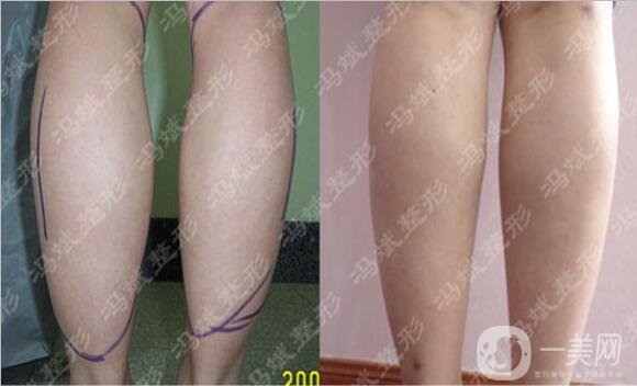 北京東方和諧馮斌整形價格表2018國慶特惠出爐