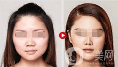 溶脂多少錢 溶脂具體價(jià)格透露