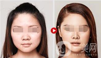 溶脂多少錢 溶脂具體價(jià)格透露