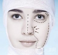 上海一個(gè)鼻部手術(shù)大概多少錢(qián)？?jī)r(jià)格盤(pán)點(diǎn)！