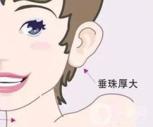 玻尿酸豐耳垂怎么樣 豐耳垂前后圖