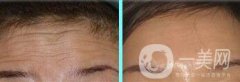 抬頭紋很重怎么辦?*去除抬頭紋方法介紹