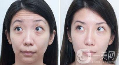 抬頭紋很重怎么辦?*去除抬頭紋方法介紹