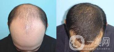 北京植發(fā)醫(yī)院信息介紹？哪里植發(fā)好？