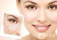 像素激光調(diào)節(jié)痘坑果怎么樣？