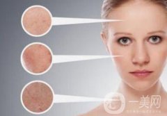 像素激光祛斑價(jià)格一般是多少？果好嗎？