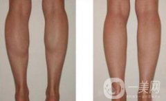 在上海注射瘦臉瘦小腿需要多少錢(qián)