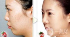 正規(guī)醫(yī)院做果酸換膚要多少錢(qián)？