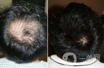 fue植發(fā)缺點和優(yōu)點分別是什么