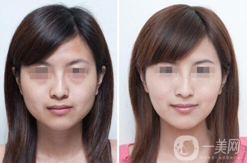 打完*能維持多長(zhǎng)時(shí)間