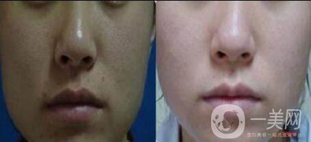 做一次黑臉娃娃需要多少錢(qián)