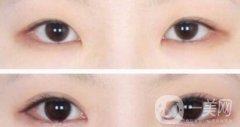 開眼角手術(shù)醫(yī)院介紹？開眼角哪好？