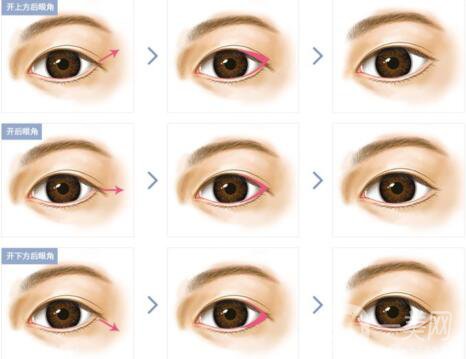 開眼角手術(shù)醫(yī)院介紹？開眼角哪好？