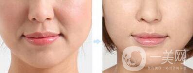 上海正規(guī)醫(yī)院去法令紋少錢