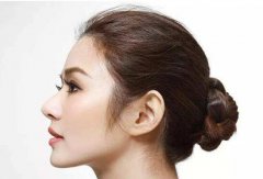 在武漢做專業(yè)隆鼻修復(fù)多少錢(qián)