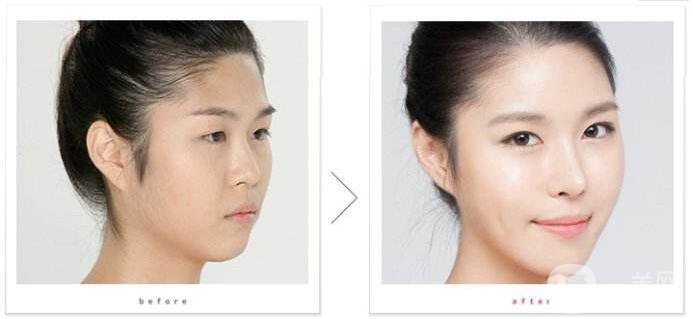 在武漢做專業(yè)隆鼻修復多少錢