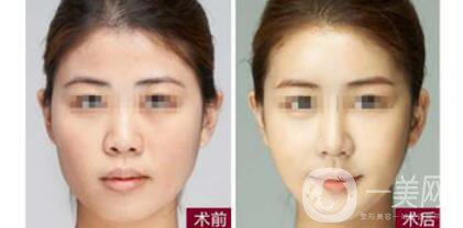 成都注射*一針多少錢