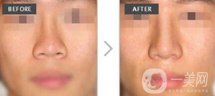 成都朝天鼻整容大概要多少錢