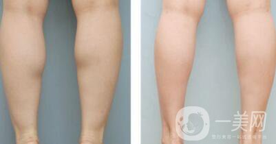 在深圳打*一般多少錢(qián)