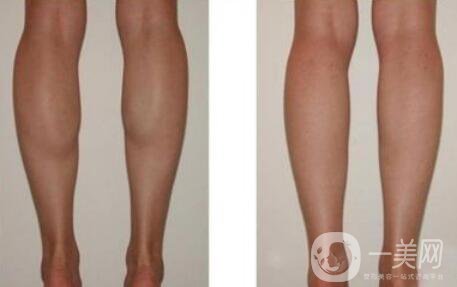 在深圳打*一般多少錢(qián)