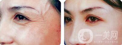 *注射去皺大概幾天見*