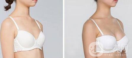 妙桃假體豐胸大概多少錢一次