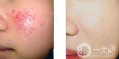 果酸換膚的副作用？果酸換膚幾天恢復(fù)？