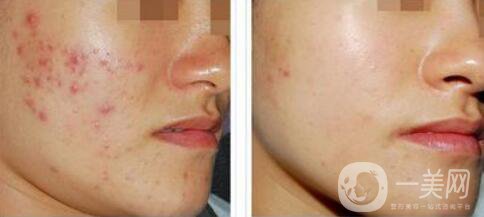 果酸換膚的副作用？果酸換膚幾天恢復(fù)？