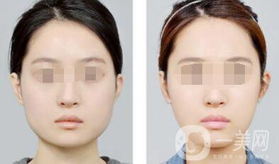 南京注射**價格是多少