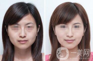 南京注射**價格是多少