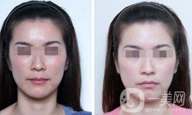 北京正規(guī)醫(yī)院嫩膚具體多少錢(qián)