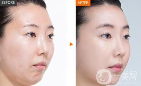 北京正規(guī)醫(yī)院嫩膚具體多少錢(qián)