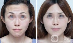 成都注射瘦臉除皺價(jià)格大概多少
