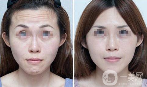 成都*除皺價(jià)格大概多少