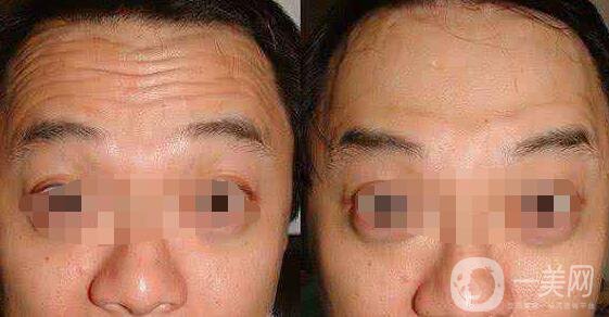 成都*除皺價(jià)格大概多少