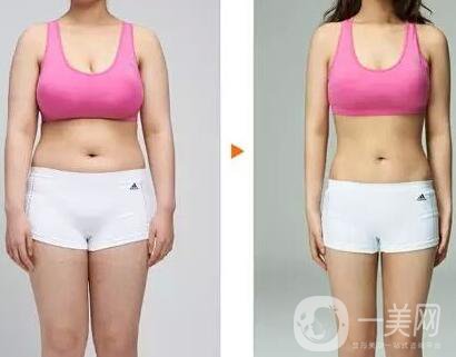 鐳射溶脂價(jià)格要多少錢(qián)？