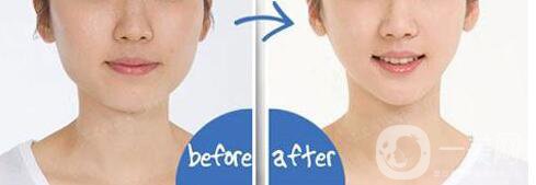 去雙下巴,多少錢