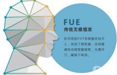 什么是fue植發(fā)，fue植發(fā)技術果怎么樣？