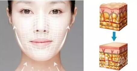 熱瑪吉緊膚除皺,多少錢