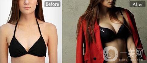 內(nèi)窺鏡隆胸,多少錢