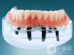 種植牙可以用多久？維持時間