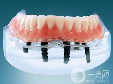 種植牙可以用多久？維持時間