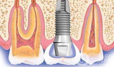 種植牙可以用多久？維持時間