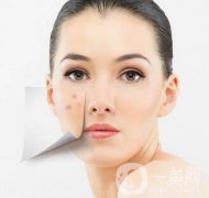 復(fù)合彩光祛痘印多久一次？